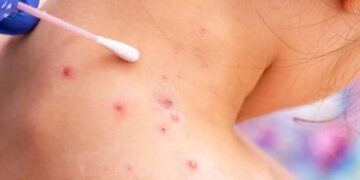 Confirma Secretaría de Salud 147 contagios de viruela símica en 18 estados